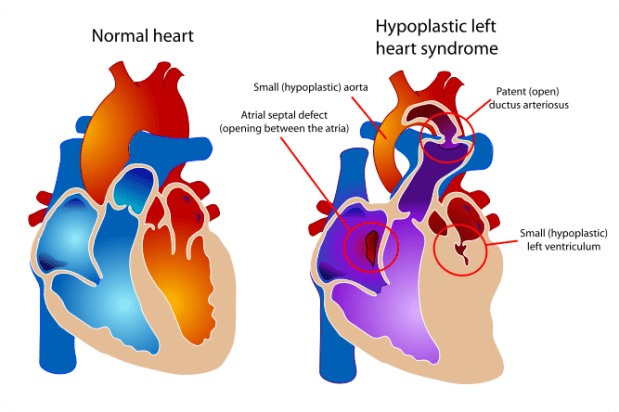 667px-Hypoplastic_left_heart_syndrome.svg